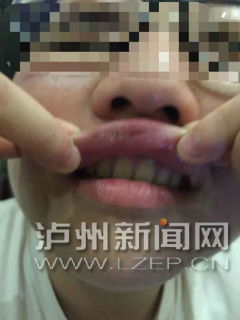 熟鸡蛋口中爆炸伤嘴唇泸州美女吓尿了