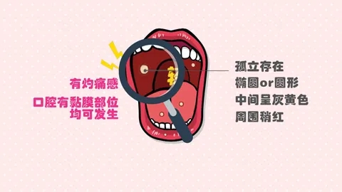 口腔溃疡别总怪"上火,3个tips拯救你!