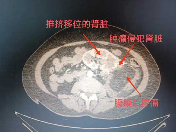 19cm“腹内炸弹”比拳头大2倍，5小时抢回命！