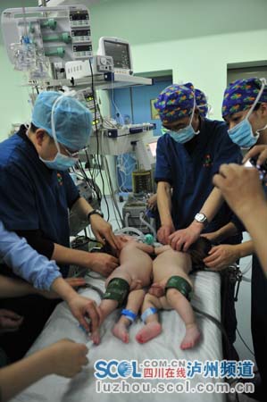 泸州医学院附属医院第四例连体婴成功分离状况良好