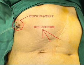 反复开刀，肝内胆管结石还是复发？医生从一个“小通道”取石